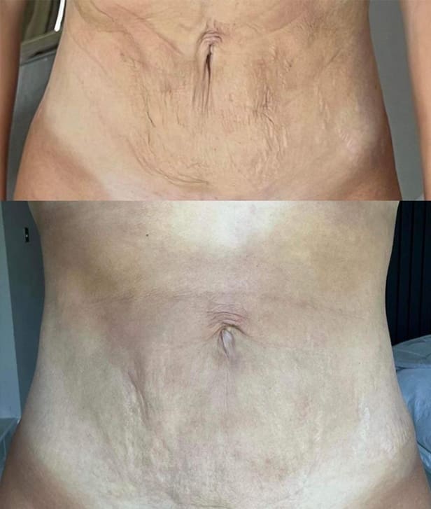 Morpheus8 Body Before and After Beau Clinic Kent