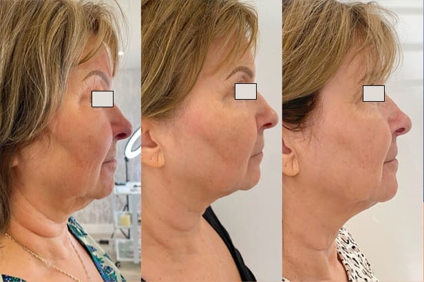 Morpheus8 Full Face and Neck Before and After Beau Clinic Kent