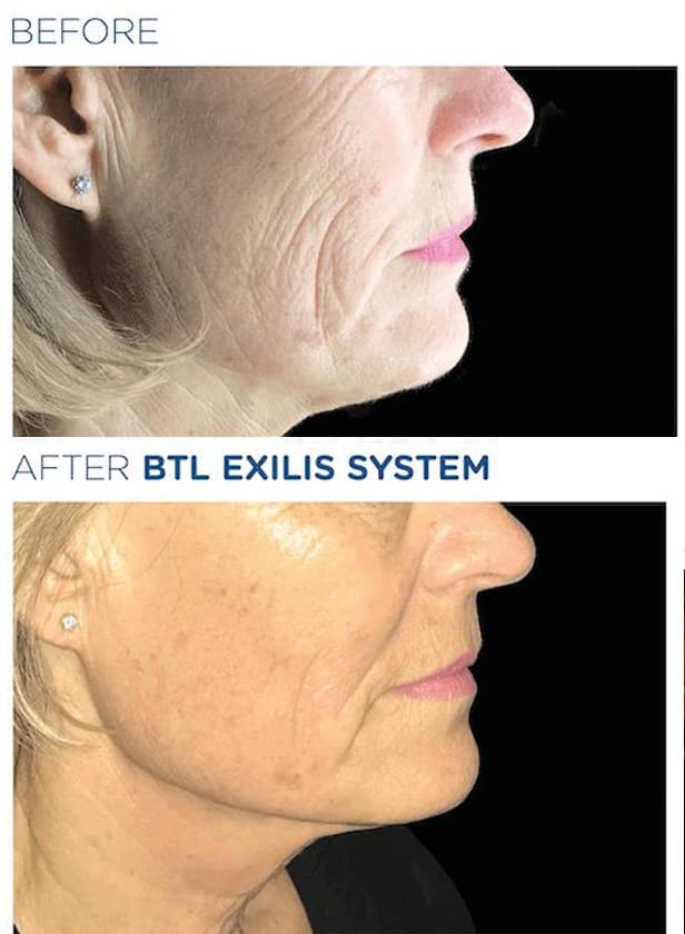 Exilis Skin Tightening Beau Clinic Kent